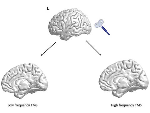 Low Vs High Frequency TMS
